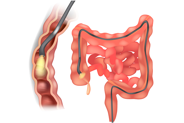 ■つらくない大腸内視鏡検査